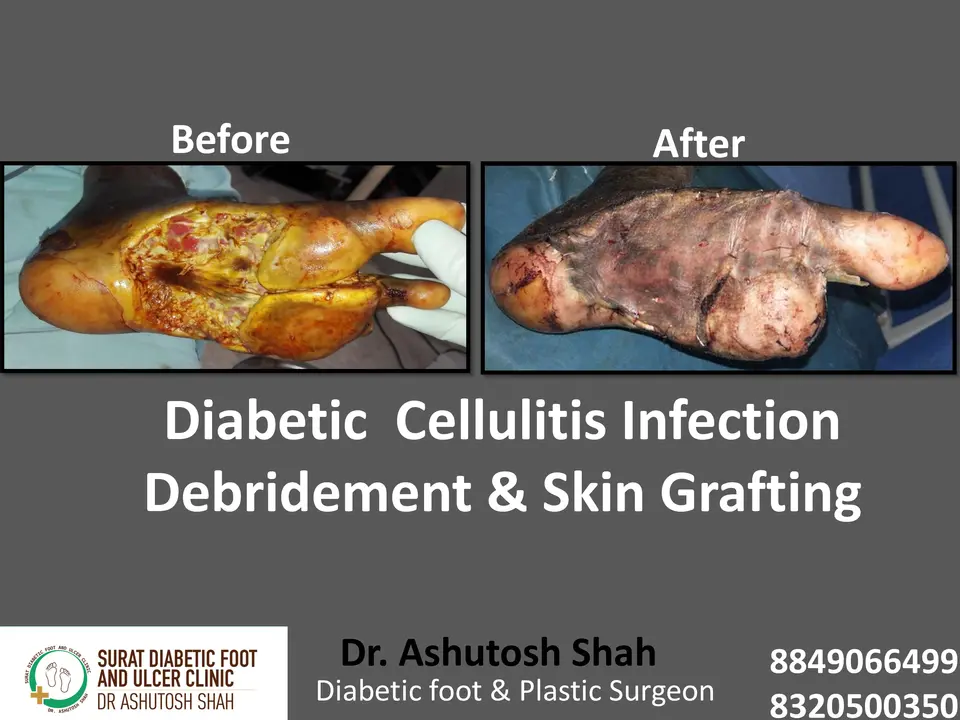 Diabetic Cellulitis and Coverage.pptx-9.webp